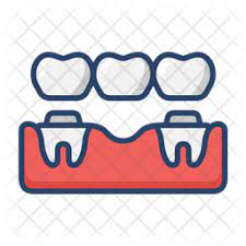 Dental bridges