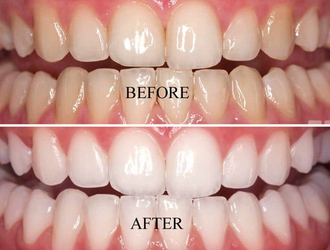 Teeth whitening