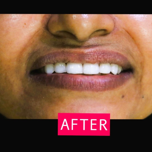 After-Dental-1